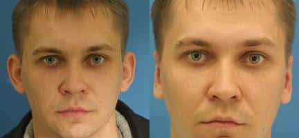 Otoplasty to correct the position of the ears. After surgery, ears are closer to the head to create a more balanced facial contour.