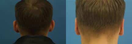 patient-12623-otoplasty-ear-surgery-before-after-3