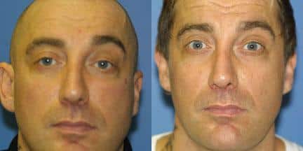 Otoplasty to improve position and symmetry of the ears on a male patient. After surgery, protruding ear is closer to head and more symmetrical with the ear on the right. the other