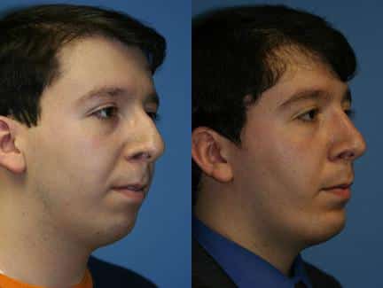 Otoplasty to correct ear position, rhinoplasty to improve nasal bridge, and neck liposuction and implant to enhance the jawline of a male patient by Dr. Miller. Surgeries produce a more proportionate facial profile.