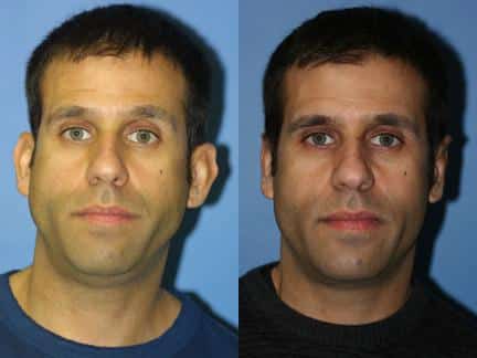Otoplasty to correct position and asymmetry of the ears of a male patient. After surgery, ears are closer to the head and create a more balanced facial contour.