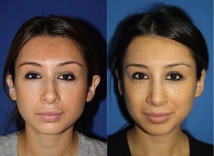 Otoplasty to improve position of the ears of a female patient. After treatment, ears are positioned closer to the sides of the head for a more attractive facial contour.