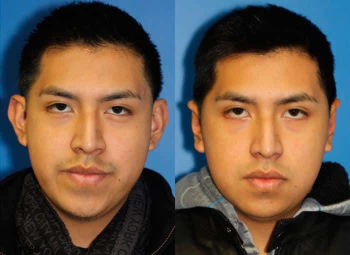 Otoplasty to adjust the position and correct asymmetry of the ears of a male patient. After surgery, left ear is positioned closer to the head for a more balanced facial contour.