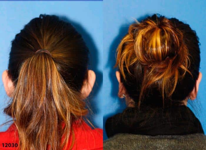 Otoplasty to correct ear position on a female patient. Surgery brings ears closer to the head for an improved head shape overall.
