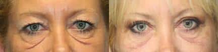 Laser treatment to rejuvenate the area around the eyes. After treatment, area under eyes is smoother and lines are visibly reduced.
