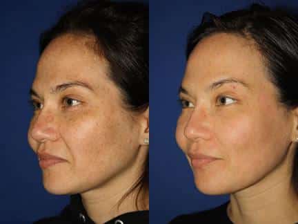 patient-12678-laser-treatments-before-after-1