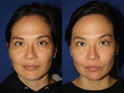 Laser treatment to reduce hyperpigmentation and rejuvenate the skin of a female patient. Brown spots are reduced after treatment and skin looks refreshed and more youthful.