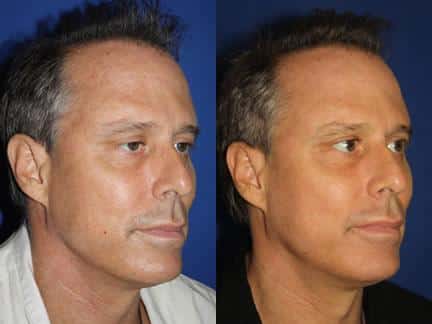 Laser treatment to rejuvenate the skin of a male patient. After procedure, skin has a more even texture and tone.