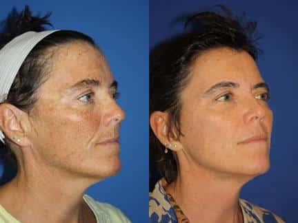 Laser treatment to address sun damage and rejuvenate the skin of a female patient. Treatment eliminates hyperpigmentation and reduces fine lines.