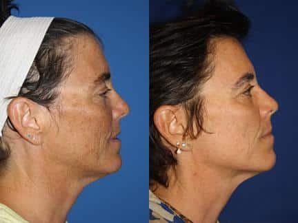 patient-12686-laser-treatments-before-after-2