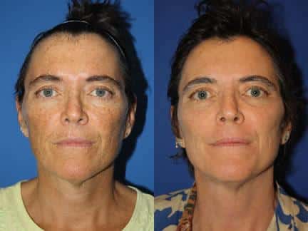 patient-12686-laser-treatments-before-after