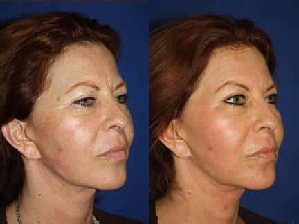 patient-12693-laser-treatments-before-after-1