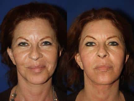 Laser treatment to smooth away wrinkles and rejuvenate the skin of a female patient. Wrinkles are visibly reduced and skin appears firmer after treatment.