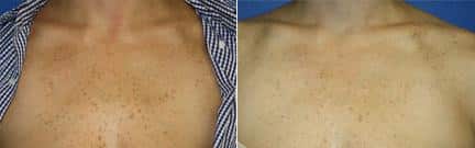 patient-12698-laser-treatments-before-after-1