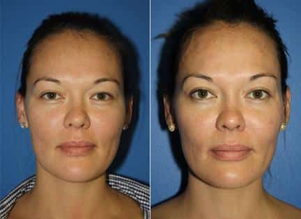 Laser treatment to rejuvenate the skin of a female patient. After the procedure, skin is smoother, clearer and more youthful.