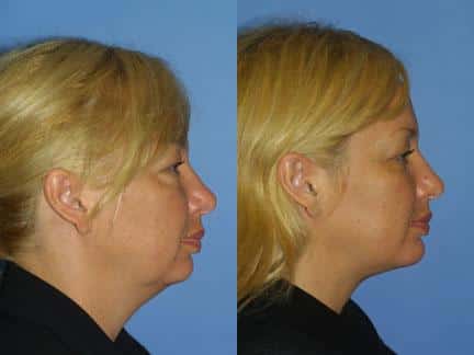 neck fat removal on a female patient in new york