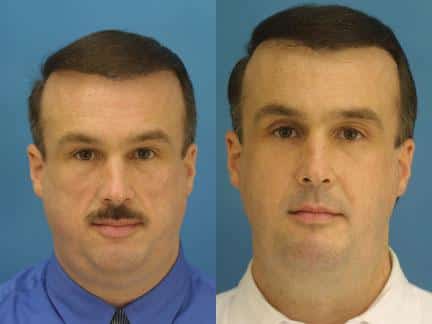 Neck liposuction to remove submental fat and sculpt the chin and neck of a male patient by Dr. Miller. After surgery, double chin is gone and patient has a more defined jawline.