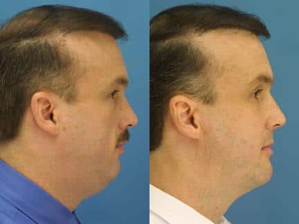 patient-12717-neck-liposuction-before-after-3