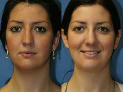 Rhinoplasty to straighten nose and neck liposuction to remove submental fat of a female patient by Dr. Miller. Surgery adds proportion and definition to mid and lower face.