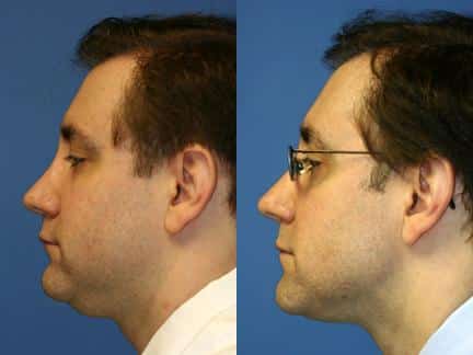 neck fat removal before and after