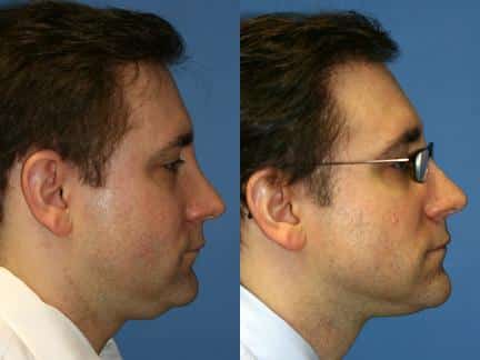 Neck liposuction to treat submental fat and sculpt the neck and jawline of a male patient by Dr. Miller. After treatment, double chin is significantly reduced and there is a smoother transition from the chin to the neck.
