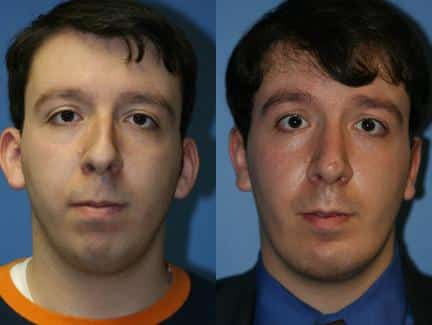 Otoplasty to correct the ears, rhinoplasty to correct the nose and neck liposuction and an implant to enhance the jawline of a male patient by Dr. Miller. Surgeries create more balanced, proportionate facial contour.