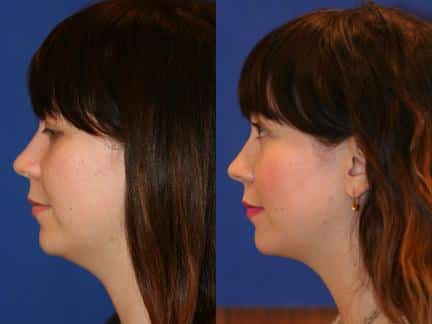 Neck liposuction to eliminate submental fat and improve the profile of a female patient by Dr. Miller. Surgery creates a smoother transition from the chin to the neck.