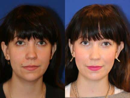 patient-12751-neck-liposuction-before-after