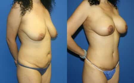 patient-12756-body-makeover-before-after-1