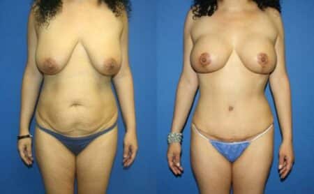 patient-12756-body-makeover-before-after