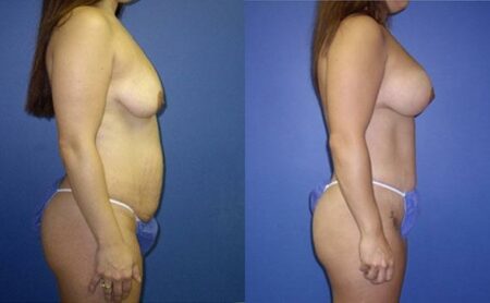 patient-12763-body-makeover-before-after-1