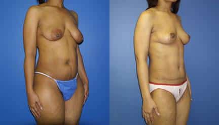 patient-12775-body-makeover-before-after-1