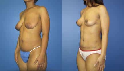 patient-12775-body-makeover-before-after-2