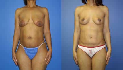 patient-12775-body-makeover-before-after