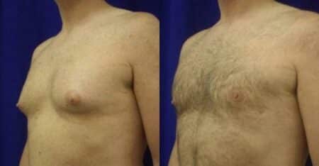 patient-12795-gynecomasty-male-pectoral-before-after-1