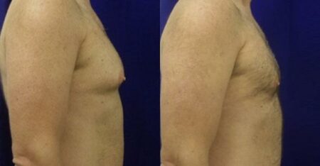 patient-12795-gynecomasty-male-pectoral-before-after-2