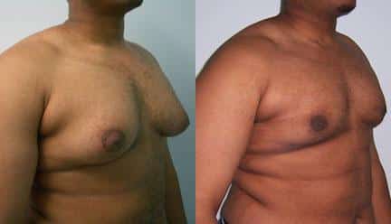 patient-12804-gynecomasty-male-pectoral-before-after-1