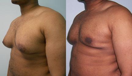 Male Breast Reduction/Gynecomastia New York City