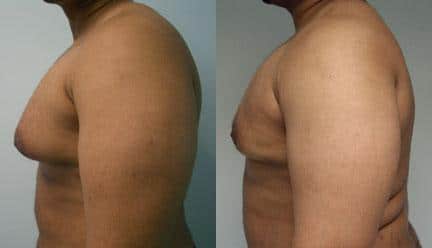 patient-12804-gynecomasty-male-pectoral-before-after-4
