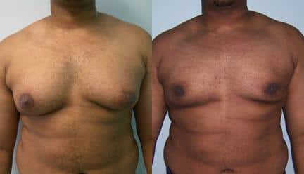 patient-12804-gynecomasty-male-pectoral-before-after