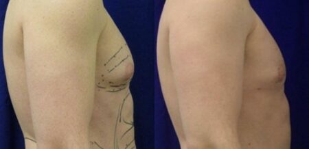 patient-12815-gynecomasty-male-pectoral-before-after-1