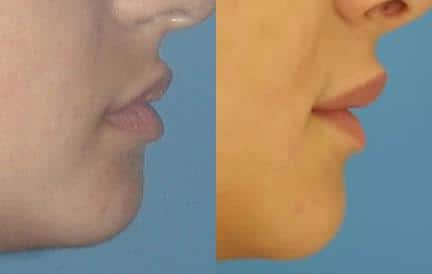 Lip fillers to add fullness and enhance the profile of a female patient by Dr. Miller. After treatment, lips are more defined and proportionate to other features.