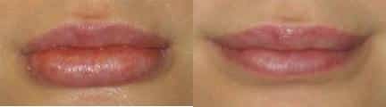 Lip reduction to reduce lip size and bring them into proportion with other facial features of a female patient by Dr. Miller. Treatment creates a more aesthetically pleasing shape and contour to the mouth.