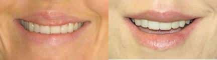 Lip reduction to improve the size and shape of the upper lip of a female patient by Dr. Miller. Surgery creates a more aesthetically pleasing lip shape while creating proportion with the lower lip.