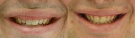 Lip reduction to improve the size and shape of the upper lip of a male patient by Dr. Miller. After surgery, upper lip is proportionate and has a more aesthetically pleasing shape.