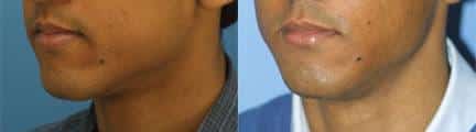 patient-12868-lip-enhancement-before-after-7