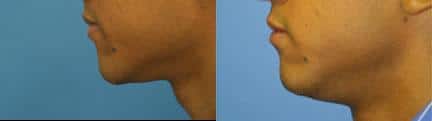 patient-12868-lip-enhancement-before-after-8