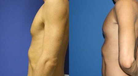 patient-12875-chest-augmentation-before-after-2