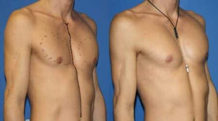 patient-12875-chest-augmentation-before-after-3