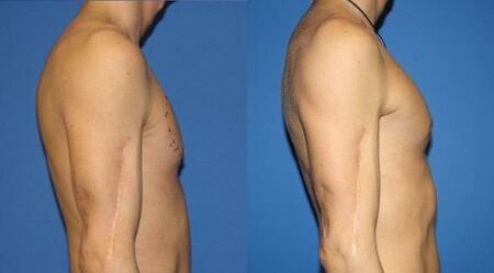 patient-12875-chest-augmentation-before-after-4